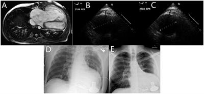 Heart Transplantation in Mustard Patients Bridged With Continuous Flow Systemic Ventricular Assist Device - A Case Report and Review of Literature